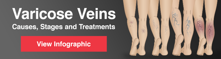 Varicose Veins Infographic